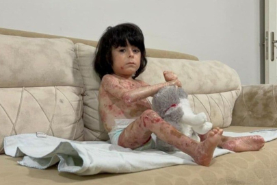 Bursa’da 4 yaşındaki İbrahim’in 'kelebek hastalığı' hayatını zorlaştırıyor